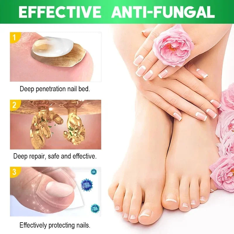 Fungal Nail Treatment Cream