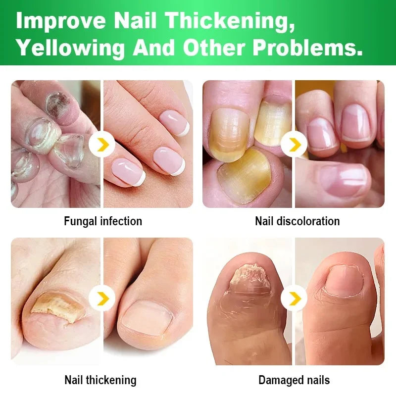 Fungal Nail Treatment Cream