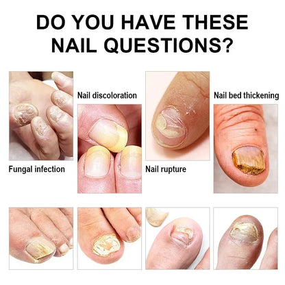 Fungal Nail Treatment Cream